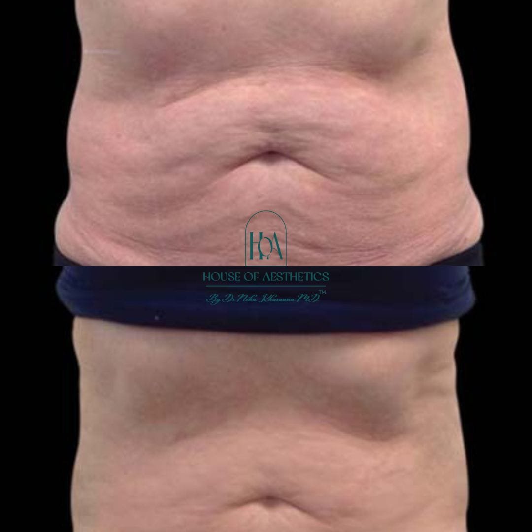 Hifu Treatment in Greater Kailash 7 slider2