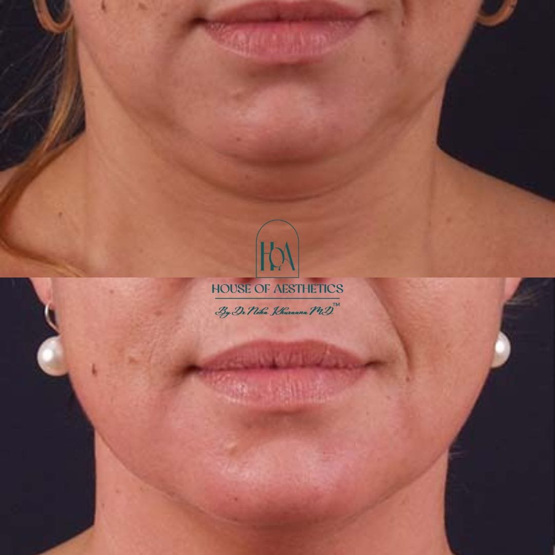 Hifu Treatment in Greater Kailash 5 slider3
