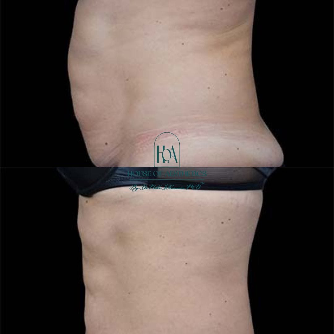 Hifu Treatment in Greater Kailash 9 slider4