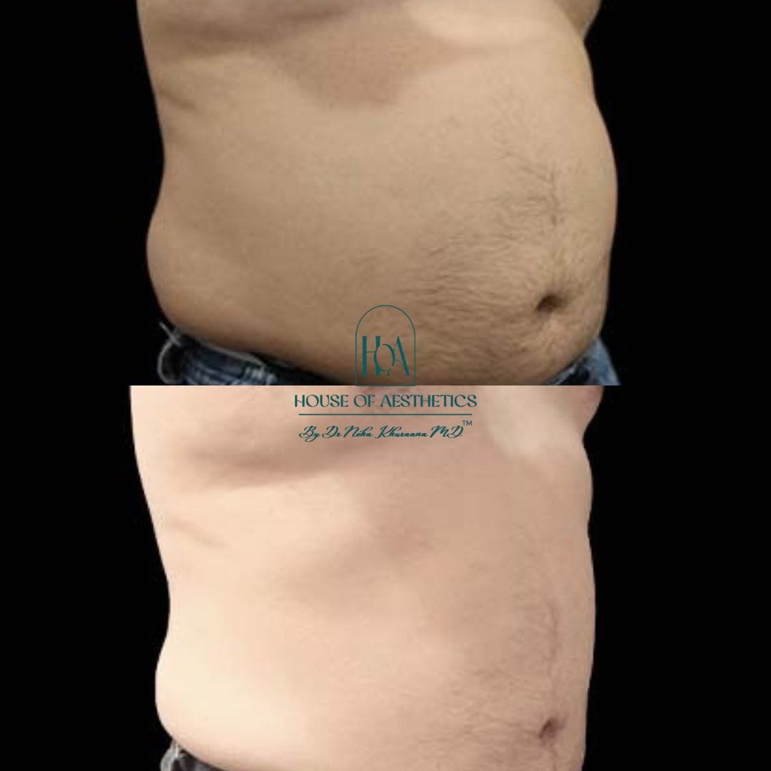 Hifu Treatment in Greater Kailash 8 slider5