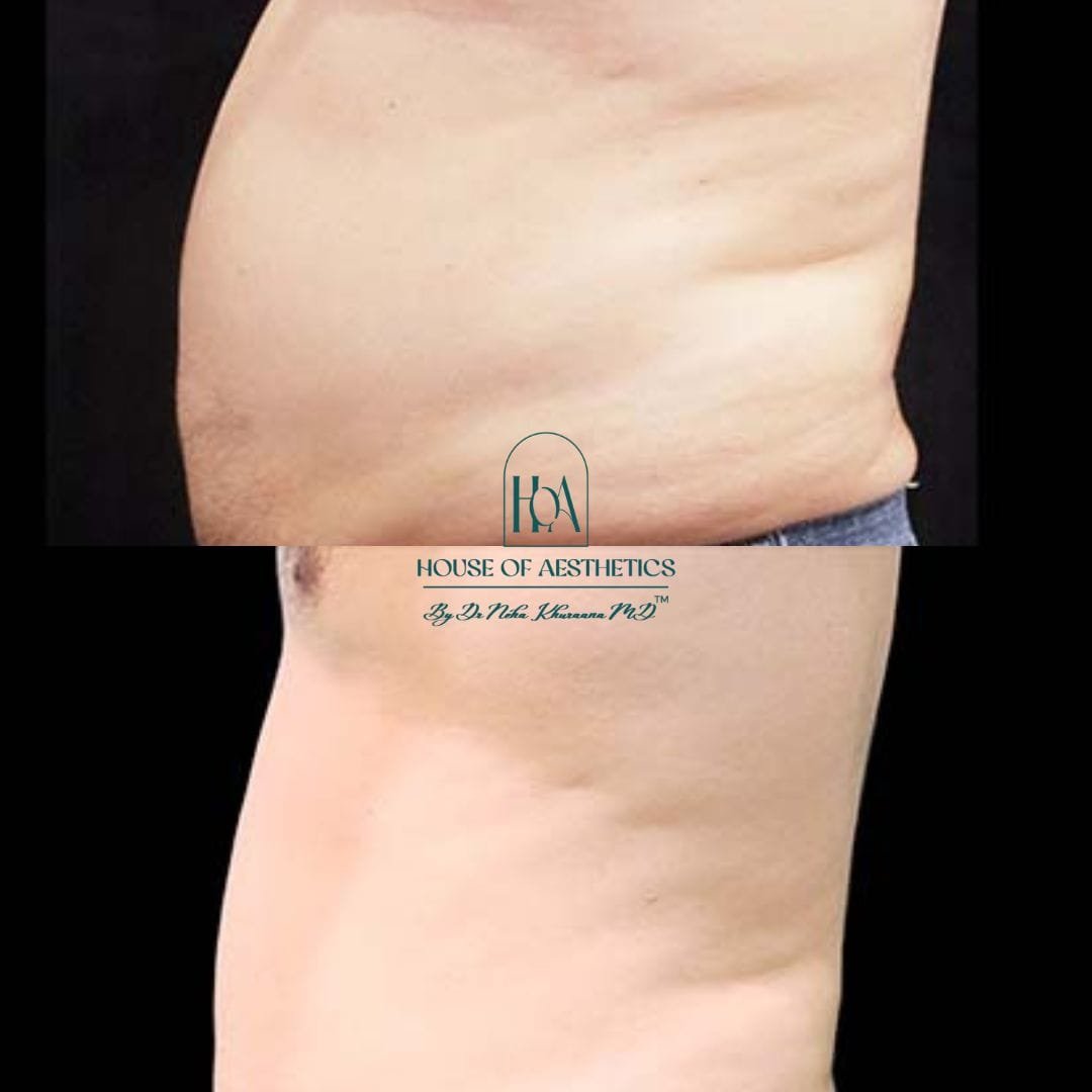 Hifu Treatment in Greater Kailash 6 slider6