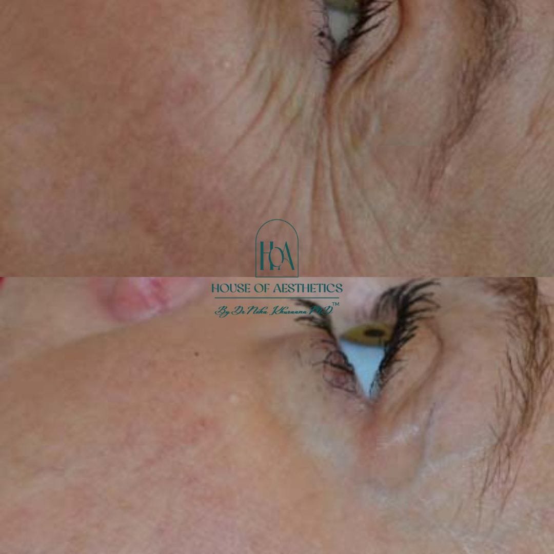 Hifu Treatment in Greater Kailash 3 slider7 (1)