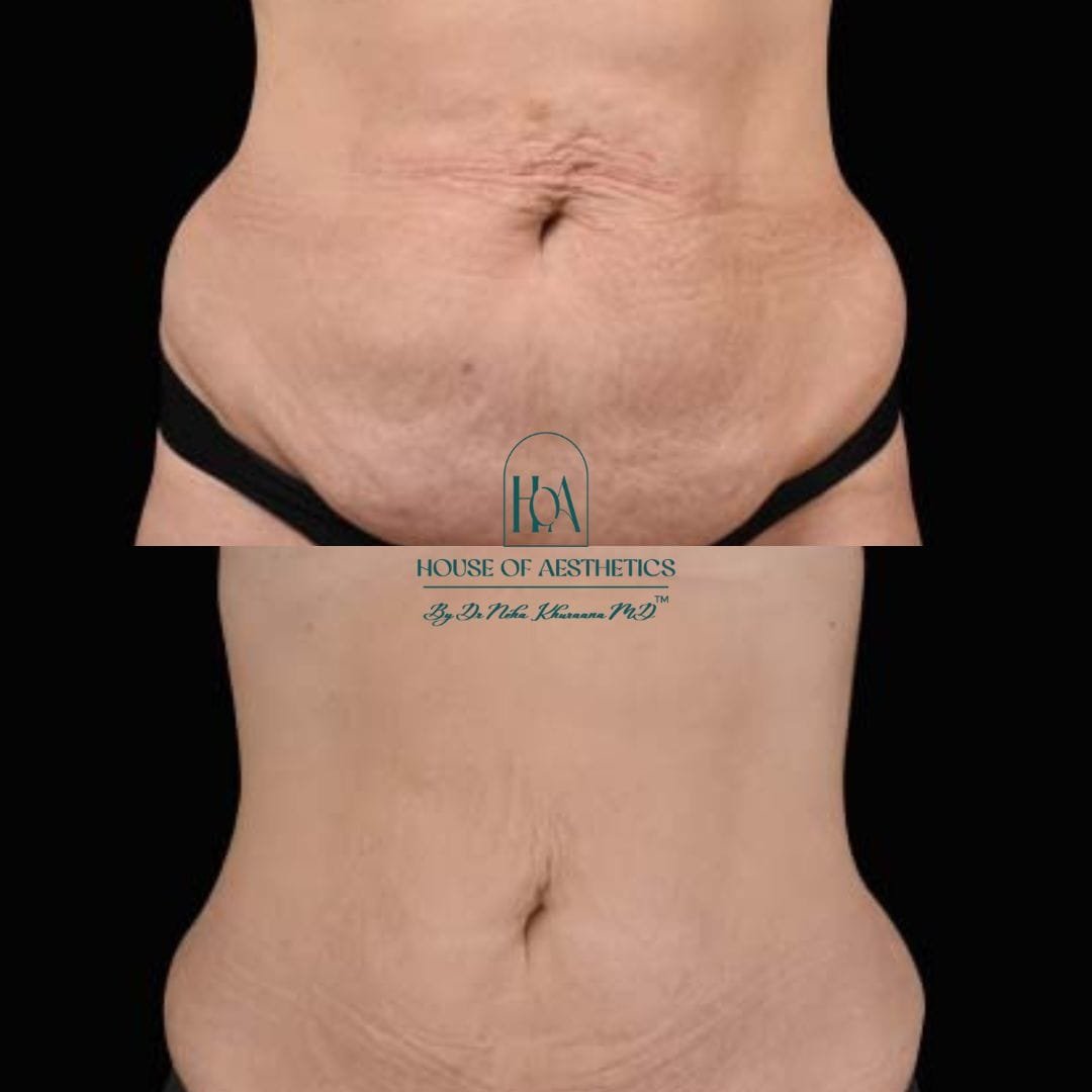 Hifu Treatment in Greater Kailash 4 slider7