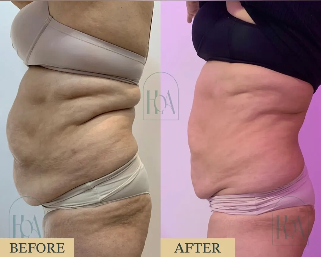 Lipolysis Injections at HOA Body Lab lipolysis1
