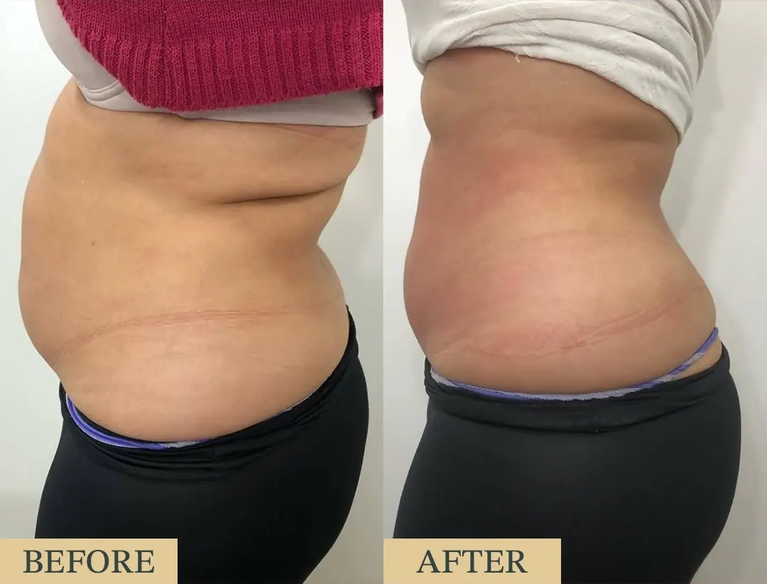 Lipolysis Injections at HOA Body Lab lipolysis2