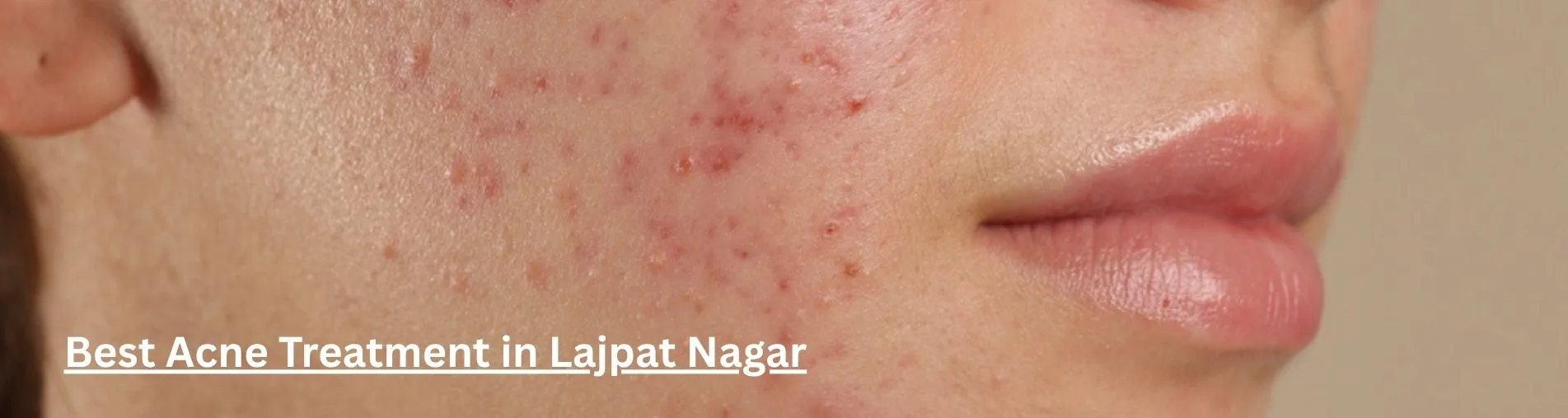 Best Acne Treatment in Lajpat Nagar, Delhi
