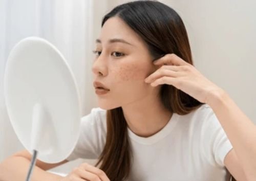 Best Treatment For Acne Acne Scars In Delhi