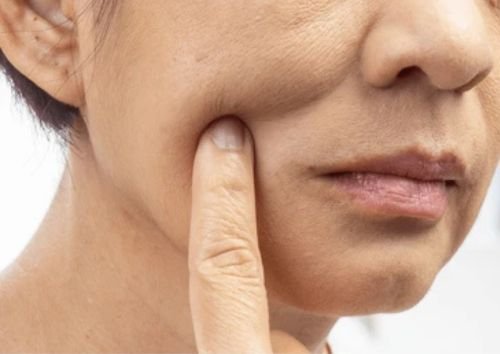 Best Treatment For Acne Acne Scars In Delhi