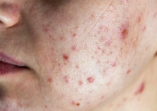 Best Treatment For Acne Acne Scars In Delhi