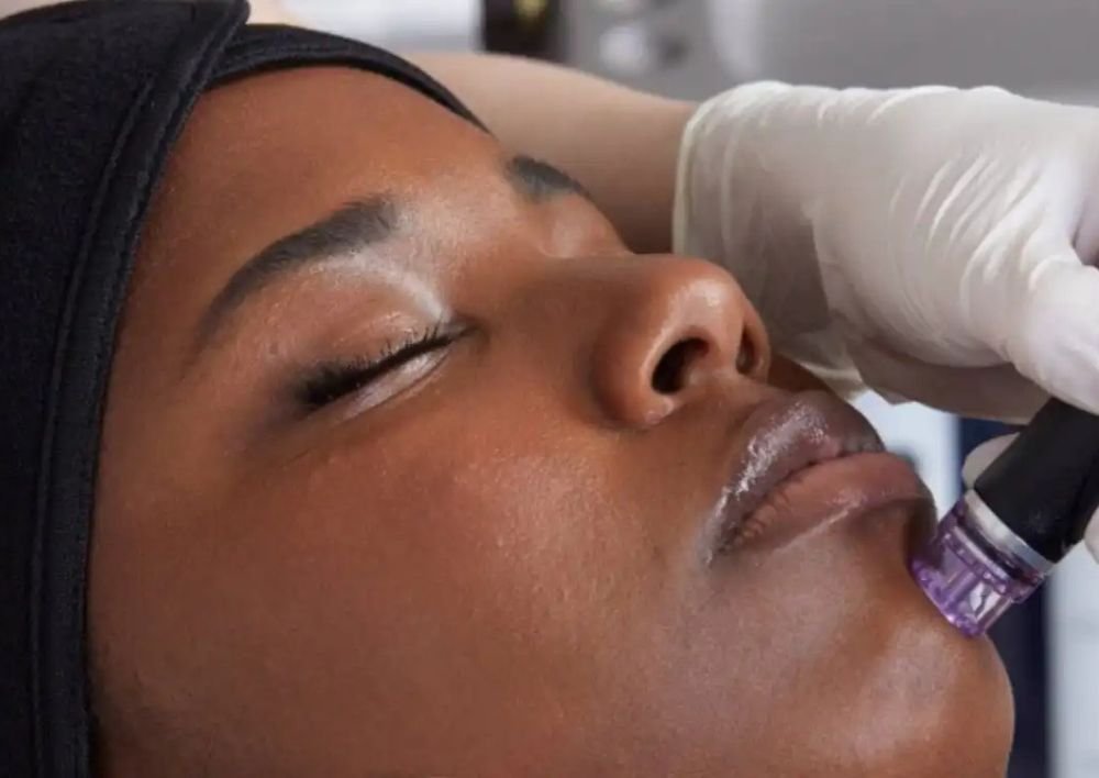 Best Treatment For Acne Acne Scars In Delhi