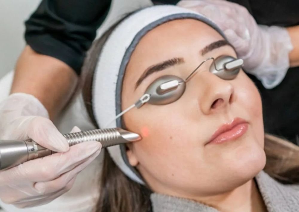 Best Treatment For Acne Acne Scars In Delhi