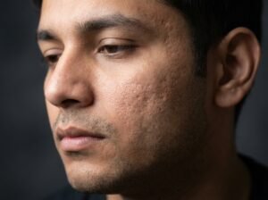 Read more about the article Acne Scars: Types, Causes & Best Treatments Available in Delhi