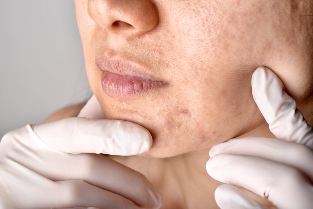 Acne Scar Treatment in Delhi: Which Option Actually Works for Your Scar Type