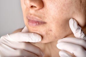 Read more about the article Acne Scar Treatment in Delhi: Which Option Actually Works for Your Scar Type