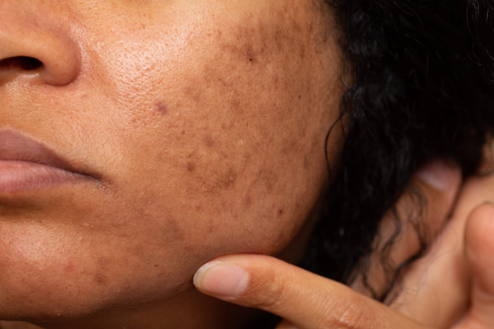 You are currently viewing Chemical Peel vs Microneedling vs Laser for Pigmentation: A Comparison